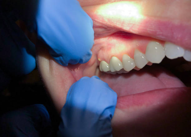 Best Emergency Dental Care for Abscessed Tooth in Pottsville, PA